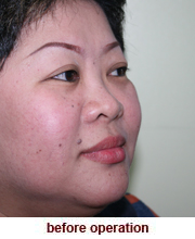 plastic_surgery_augmentation_rhinoplasty